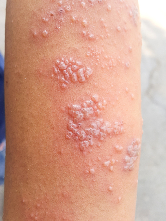 Herpes en el brazo tratamiento